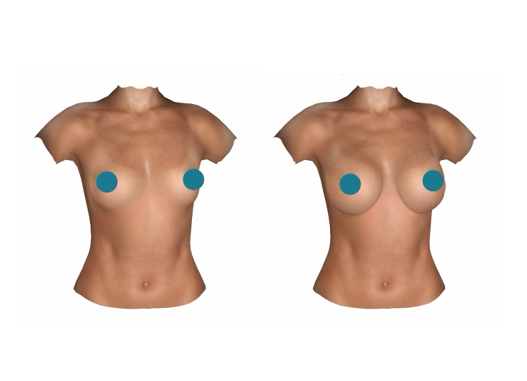 Breast reduction  Ms Angelica Kavouni Cosmetic Plastic Surgeon