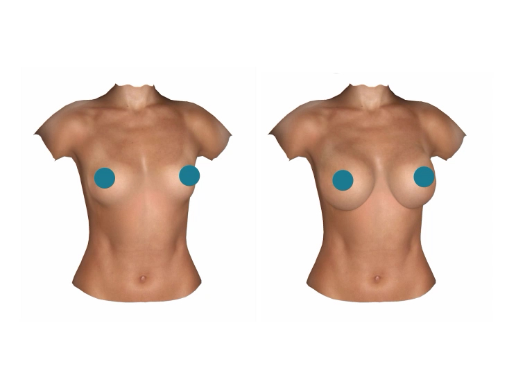 Breast Reduction  La Clinique Privée