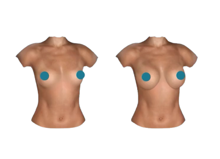 Breast Augmentation - iMed Medical